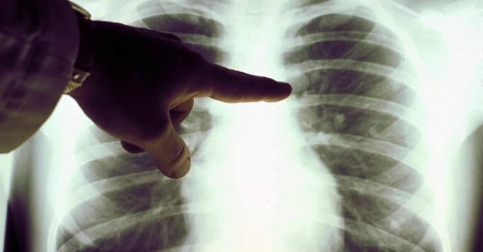 Ung thư phổi trở thành căn bệnh ung thư hàng đầu ở phụ nữ Trung Quốc, tỷ lệ mắc bệnh có xu hướng gia tăng缩略图