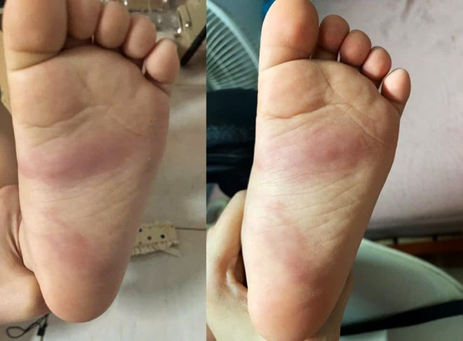 Hưng Yên: Xác minh phản ánh trẻ 3 tuổi bị bầm tím chân sau khi ở trường mầm non về缩略图