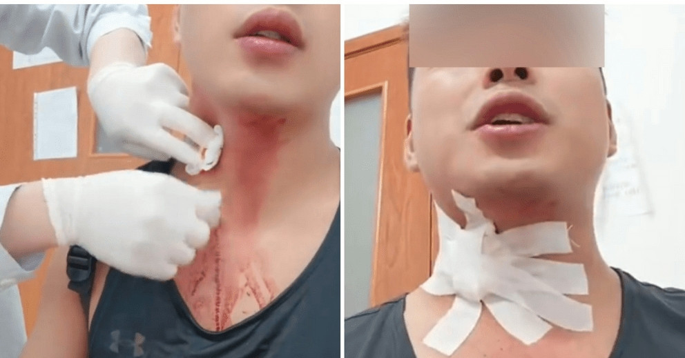 Khó tin: Nhập viện do vỡ tĩnh mạch sau khi cố đập… muỗi缩略图