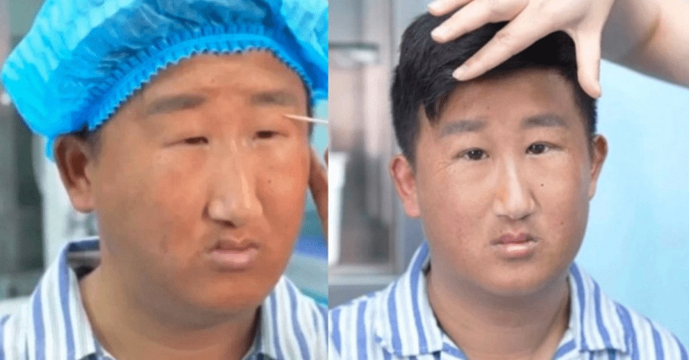 Đôi mắt sau cắt mí của nam thanh niên gây tranh cãi vì &amp;apos;trước sau như một&amp;apos;: Đánh giá của bác sĩ gây bão MXH缩略图