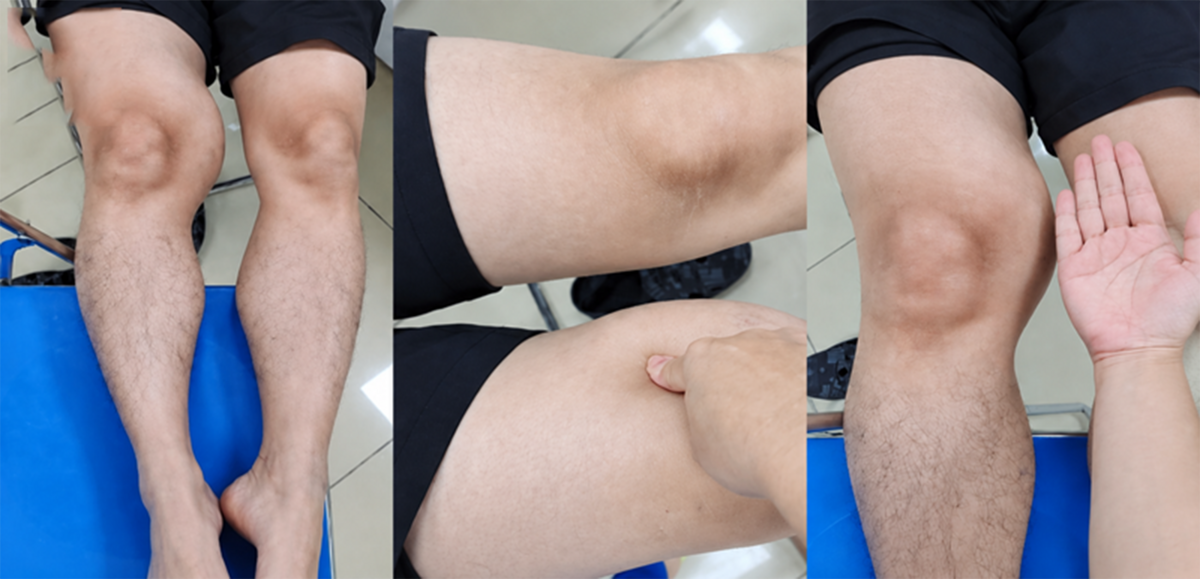 Đùi phình to như quả bóng suốt 1 năm, đi khám phát hiện ung thư hiếm gặp缩略图