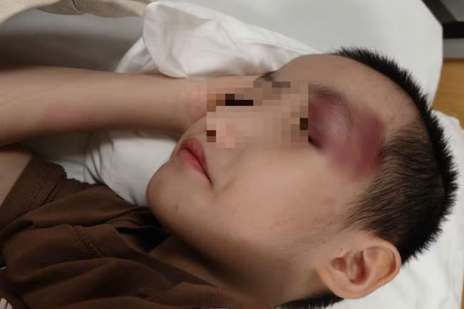 Thông tin mới vụ bé trai 6 tuổi bị chấn thương sọ não khi gửi tại cơ sở can thiệp缩略图