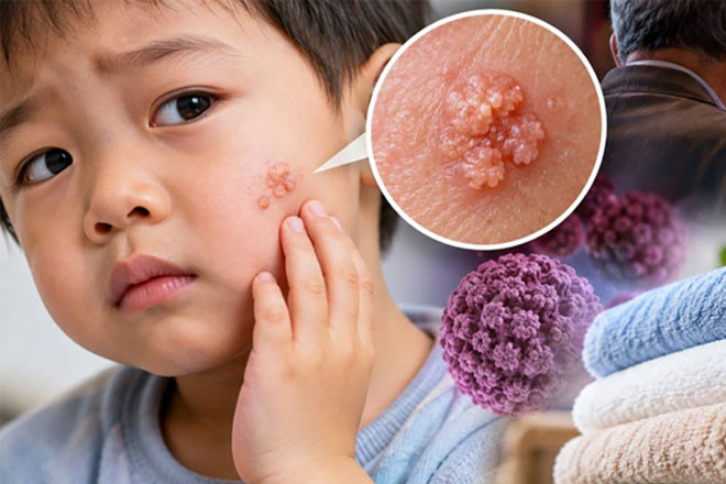 Bé trai 3 tuổi bị sùi mào gà trên mặt, bác sỹ nói do dùng chung khăn tắm缩略图